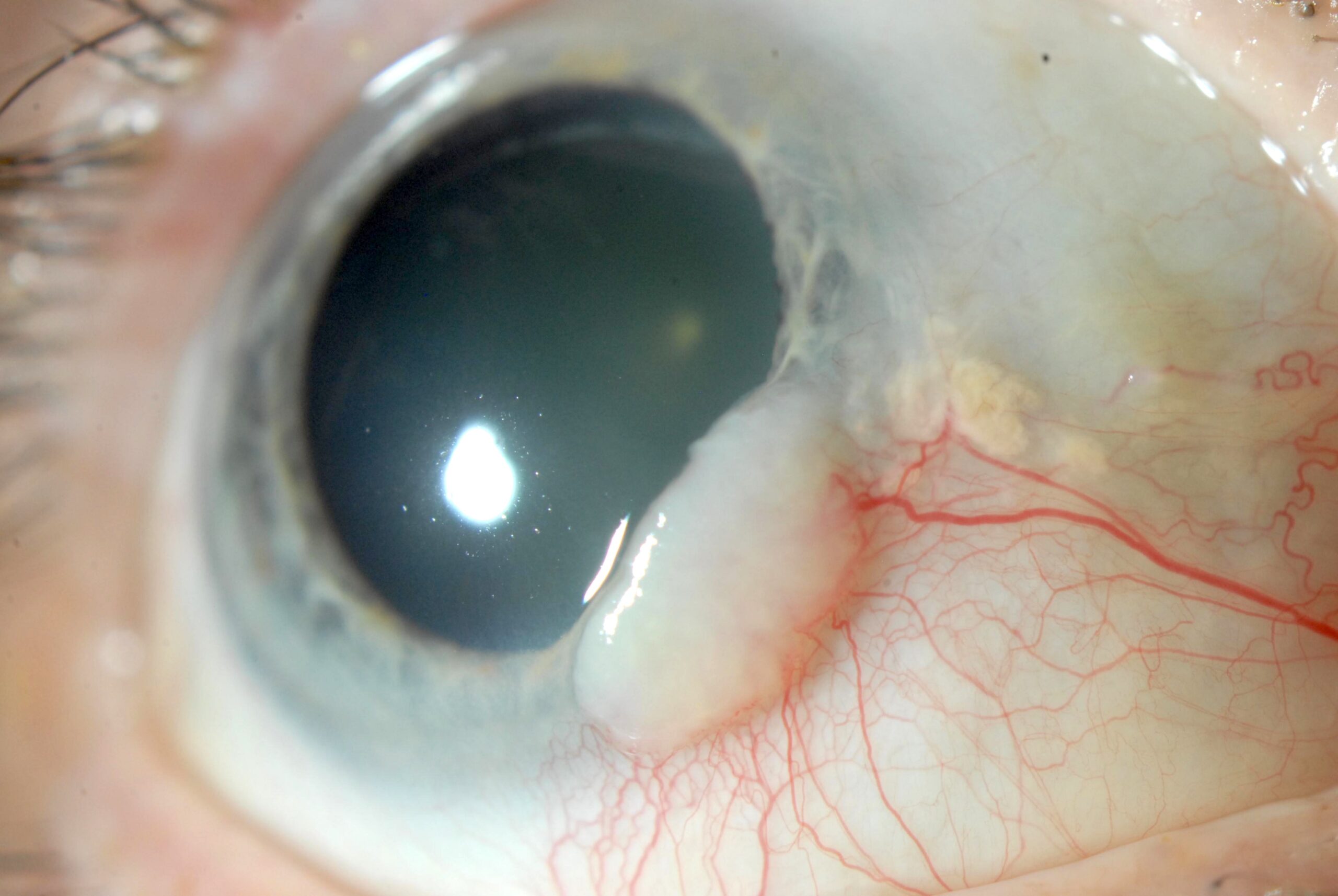 Clinical eye photograph illustrating Conjunctival Intraepithelial Neoplasia Diagnosis