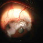 Clinical eye photograph illustrating Conjunctival Lymphoma Workup