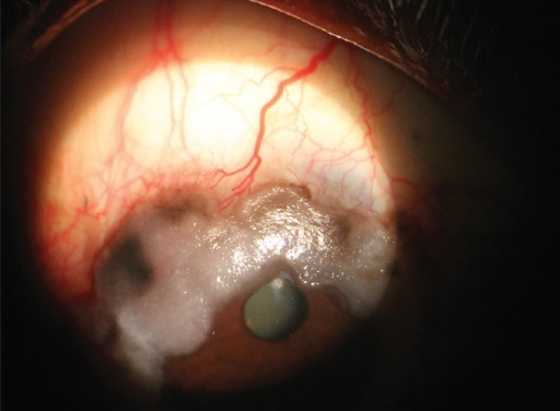 Conjunctival Lymphoma: The Salmon-Colored Mass That Requires Systemic Staging