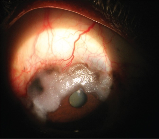 Conjunctival Lymphoma: The Salmon-Colored Mass That Requires Systemic Staging