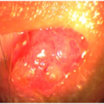 Clinical eye photograph illustrating Conjunctival Papilloma Hpv Management
