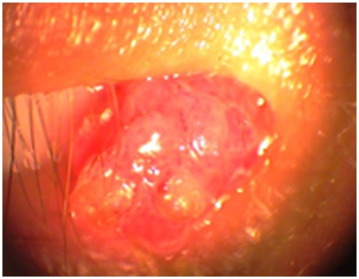 Conjunctival Papilloma: The HPV-Driven Growth That Comes in Two Very Different Ages