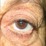 Clinical eye photograph illustrating Conjunctivochalasis Surgical Management
