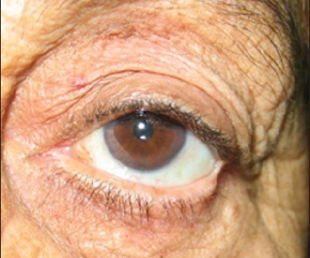 Conjunctivochalasis: The Redundant Conjunctiva Behind Unexplained Tearing