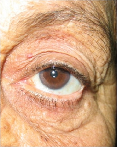 Clinical eye photograph illustrating Conjunctivochalasis Surgical Management