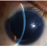 Clinical eye photograph illustrating Contact Lens Overwear Syndrome