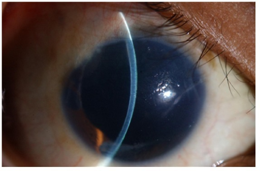 Contact Lens Overwear Syndrome: When Too Much Wear Time Catches Up With the Cornea