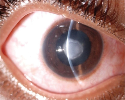 Clinical eye photograph illustrating Contact Lens Overwear Syndrome