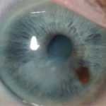Clinical eye photograph illustrating Contact Lens Related Microbial Keratitis Risk Factors