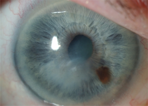 Contact Lens-Related Microbial Keratitis: The Risk Factors That Matter Most