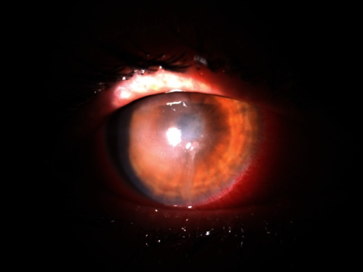 Clinical eye photograph illustrating Contact Lens Related Microbial Keratitis Risk Factors