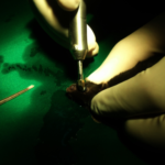 Clinical eye photograph illustrating Corneal Endothelial Decompensation Management