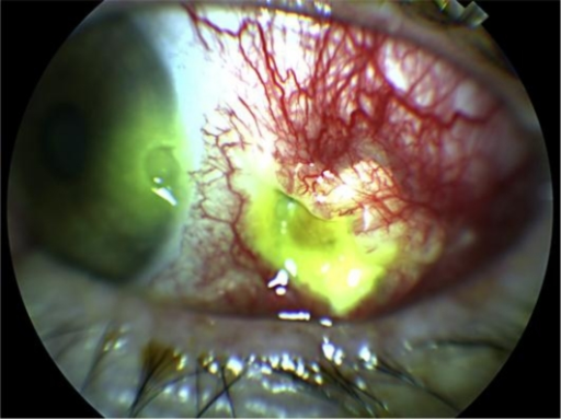 Clinical eye photograph illustrating Corneal Melt Collagen Vascular Disease