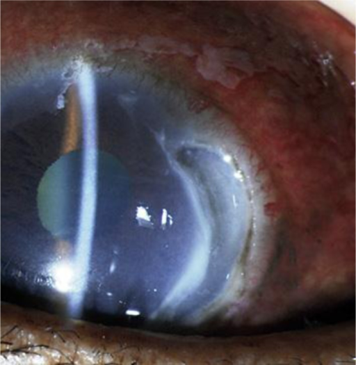 Clinical eye photograph illustrating Corneal Melt Collagen Vascular Disease