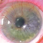 Corneal Neovascularization