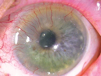Corneal Neovascularization: A Sign, Not a Diagnosis