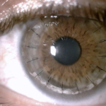 Clinical eye photograph illustrating Deep Anterior Lamellar Keratoplasty Indications