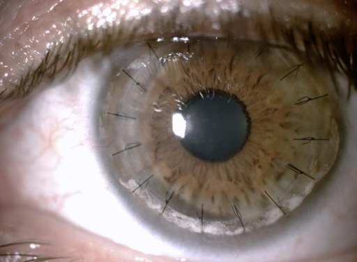 Deep Anterior Lamellar Keratoplasty: Keeping the Patient’s Own Endothelium