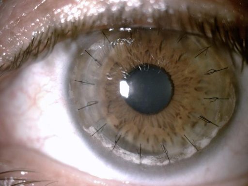 Deep Anterior Lamellar Keratoplasty: Keeping the Patient’s Own Endothelium
