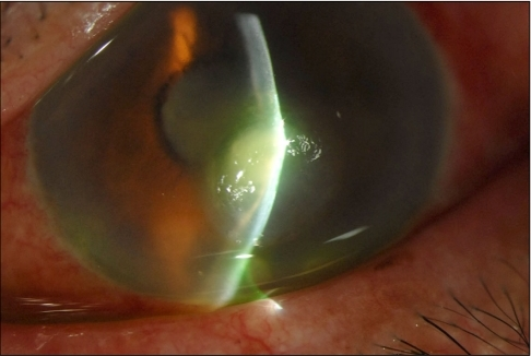 Clinical eye photograph illustrating Deep Anterior Lamellar Keratoplasty Indications