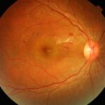 Dengue maculopathy: fundus photograph with a yellowish foveal lesion, retinal hemorrhages, and cotton wool spots