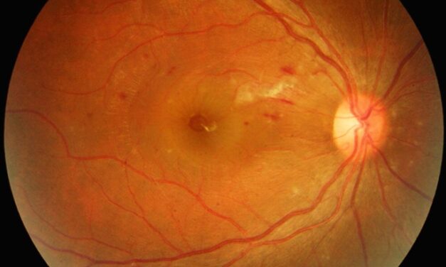 Dengue Maculopathy: Foveolitis and Macular Ischemia After a Febrile Illness