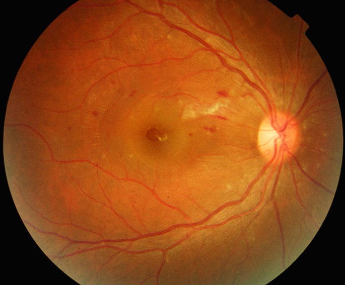 Dengue Maculopathy Foveolitis and Hemorrhages Dengue maculopathy: fundus photograph with a yellowish foveal lesion, retinal hemorrhages, and cotton wool spots