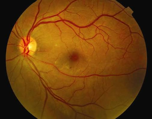 Dengue Maculopathy Macular Hemorrhage Dengue maculopathy: fundus photograph showing a small hemorrhage at the fovea after dengue fever