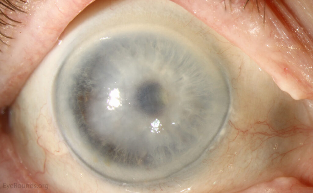 Descemet Membrane Detachment