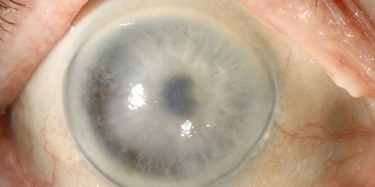 Descemet Membrane Detachment: A Post-Cataract-Surgery Cause of Localized Edema