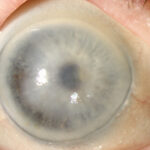 Descemet Membrane Detachment