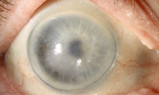 Descemet Membrane Detachment: A Post-Cataract-Surgery Cause of Localized Edema