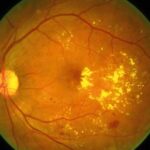 Diabetic macular edema: fundus photograph with clustered hard exudates and retinal thickening near the fovea