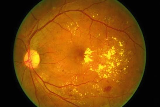 Diabetic Macular Edema: Choosing Between Observation, Anti-VEGF, Steroids and Laser