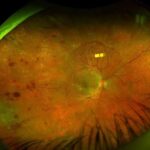 Diabetic retinopathy in pregnancy: widefield fundus image showing panretinal laser scars and scattered retinal hemorrhages