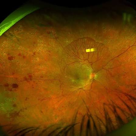Diabetic Retinopathy in Pregnancy Panretinal Laser Scars Diabetic retinopathy in pregnancy: widefield fundus image showing panretinal laser scars and scattered retinal hemorrhages