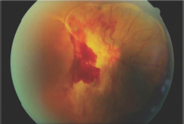 Diabetic Retinopathy in Pregnancy Proliferative Disease Diabetic retinopathy in pregnancy: proliferative disease with fibrovascular tissue and preretinal hemorrhage