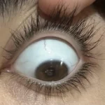 Distichiasis