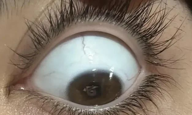 Distichiasis: An Extra Row of Lashes, and Sometimes a Syndrome