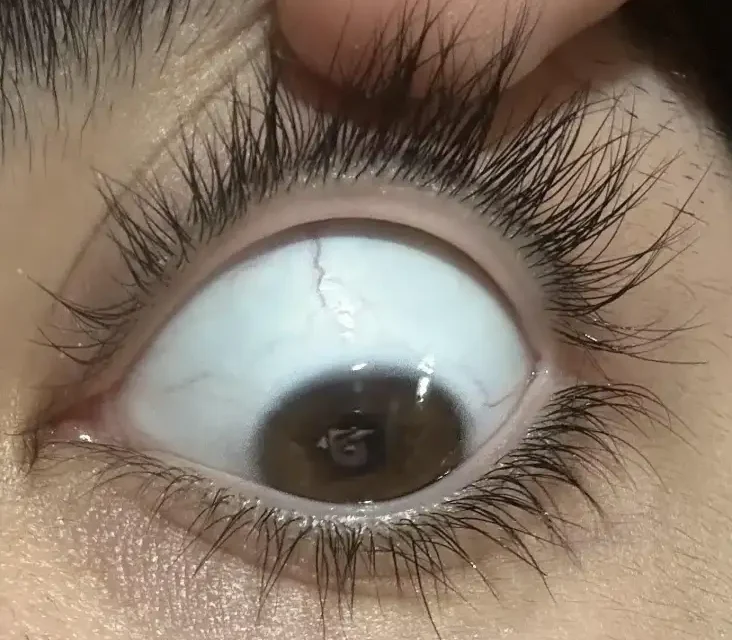 Distichiasis: An Extra Row of Lashes, and Sometimes a Syndrome