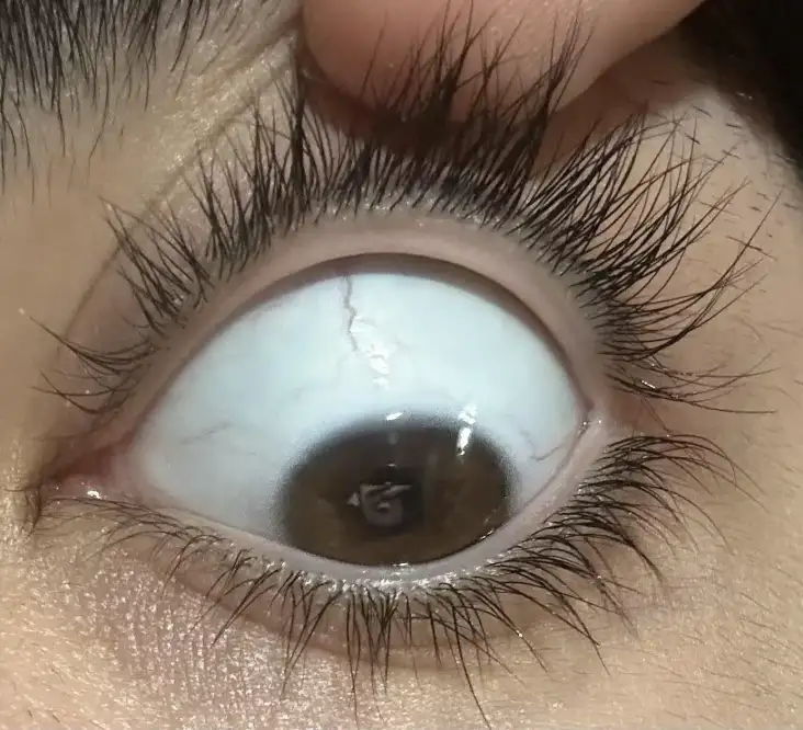 Distichiasis