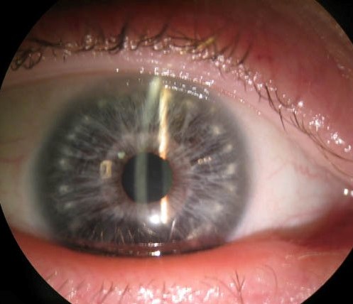Brushfield Spots: The Iris Sign Linked to Down Syndrome
