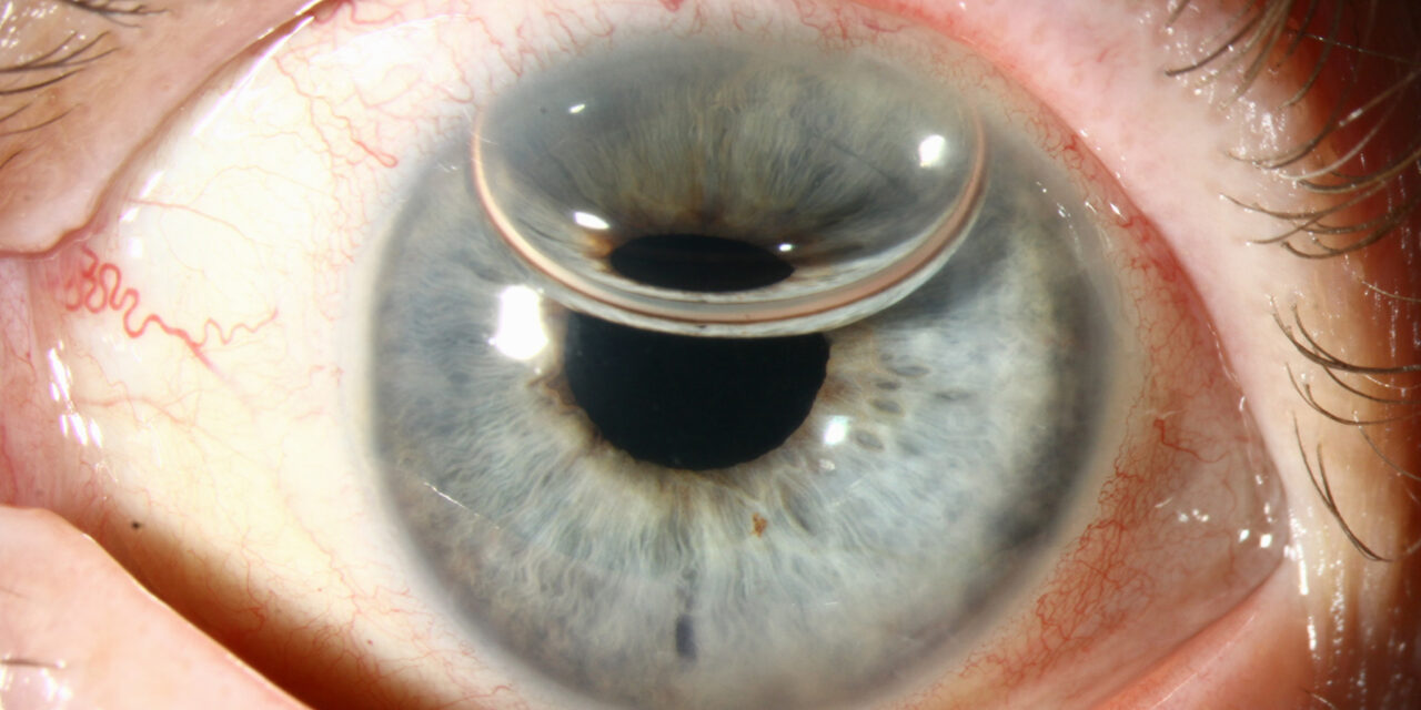 DSEK vs DMEK: Replacing Only the Cornea’s Failed Layer