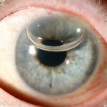 DSEK and DMEK: slit-lamp photograph of an eye undergoing endothelial keratoplasty for Fuchs endothelial dystrophy