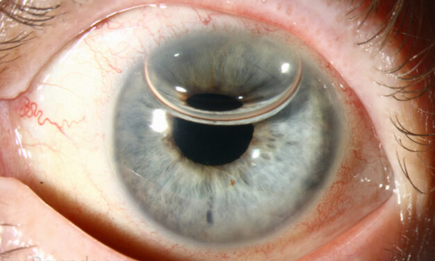 DSEK vs DMEK: Replacing Only the Cornea’s Failed Layer