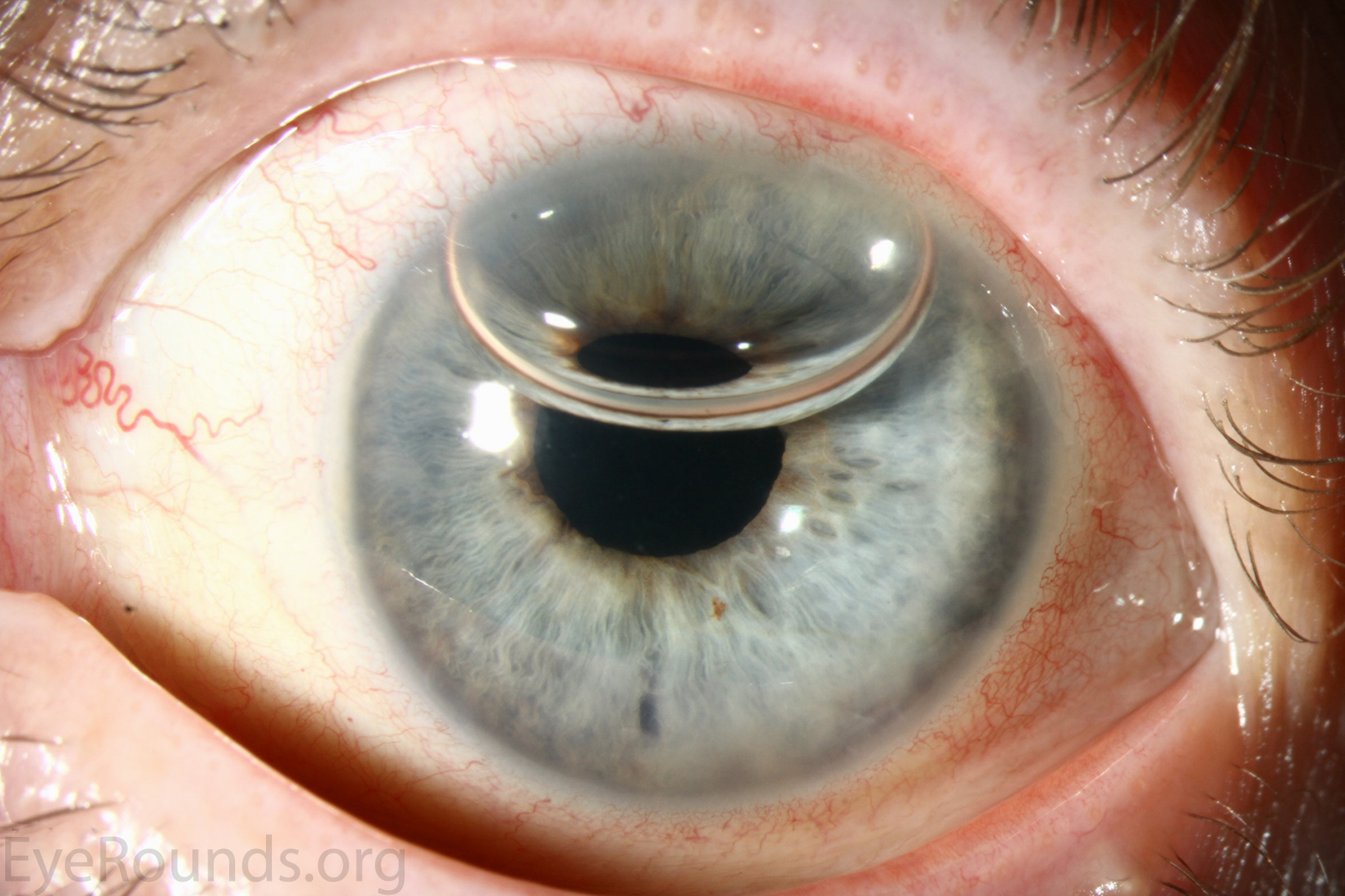 DSEK and DMEK: slit-lamp photograph of an eye undergoing endothelial keratoplasty for Fuchs endothelial dystrophy