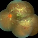 Eales disease: montage fundus photograph with perivascular sheathing, exudates, and retinal hemorrhages
