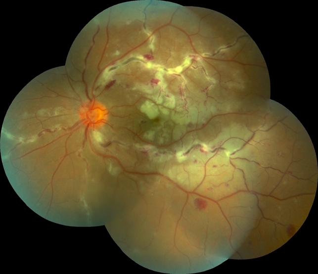 Eales Disease: A Diagnosis of Exclusion in a Young, Healthy Eye