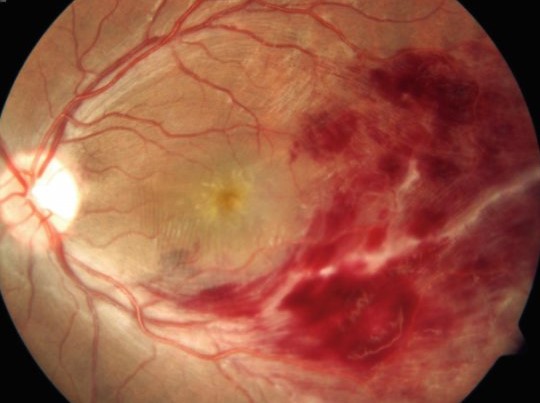 Eales disease: fundus photograph showing extensive retinal hemorrhage in the temporal macula
