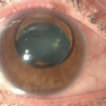 Clinical eye photograph illustrating Ectopia Lentis et Pupillae
